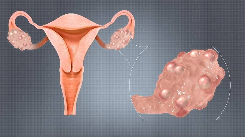 1200px-Polycystic_Ovaries 1200px-Polycystic_Ovaries